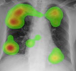 chest heatmap