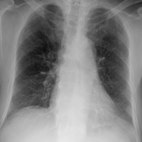 Chest X-ray